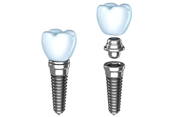 Dental implants illustration